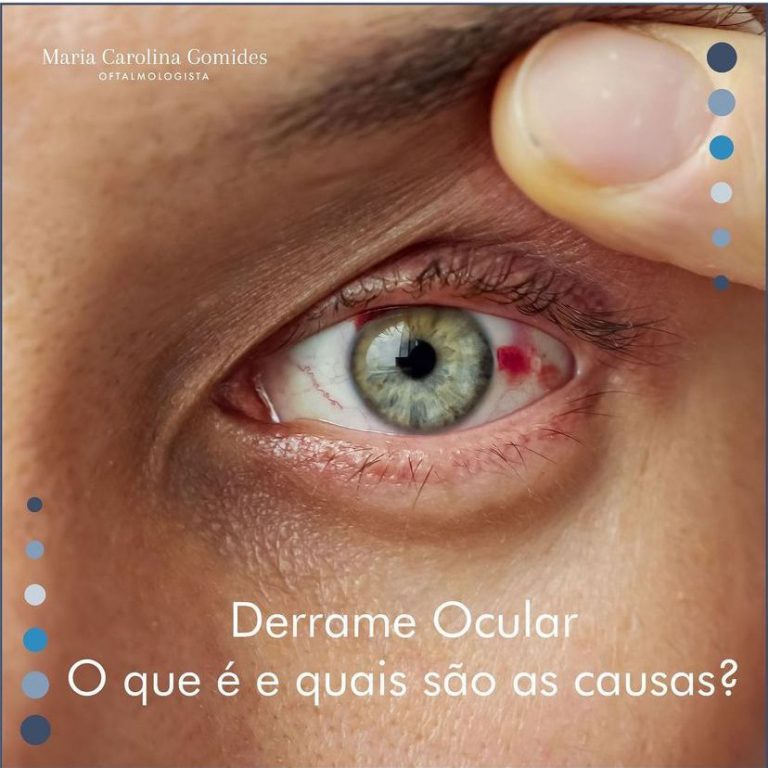 Derrame Ocular Dra Carolina Gomides Oftalmologista São Paulo SP